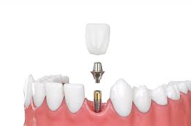 Image result for dental implant