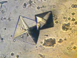 Calcium Oxalate Dihydrate Crystals C Crystals Calcium Renal Calculi