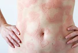Image result for Dermatographism