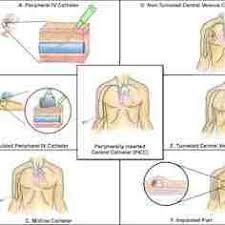 Take Your Picc The Right Line For The Right Patient