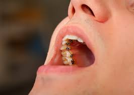 Häufig werden die fehlstellungen mittels einer zahnspange reguliert. Unsichtbare Zahnspange Mit Diesen Kosten Konnen Sie Rechnen