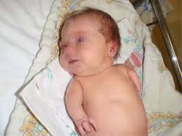 Clinical expression of Holt-Oram syndrome