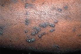 Kidney Disease 11 Ways It Can Affect Your Skin