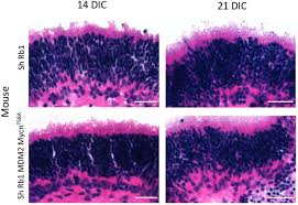 • appear years (median time 40 months) after successful treatment of. Developmental Stage Specific Proliferation And Retinoblastoma Genesis In Rb Deficient Human But Not Mouse Cone Precursors Biorxiv