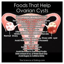 Foods To Help Health Issues Ovarian Cyst Treatment Ovarian Cyst Ovarian Cyst Symptoms