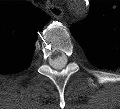 From a javascript frontend (backbone.js, require.js and jquery) to a java backend (jersey). Diagnostic Approach To Intrinsic Abnormality Of Spinal Cord Signal Intensity Radiographics