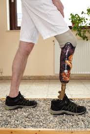 * * * * * * * * * * the man thinks this is terrible because they have just emphasized his wooden leg and so he writes a letter of complaint. What Are Prosthetics With Pictures