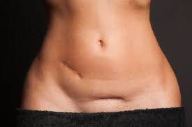 Sectio caesarea ▷ wann ist ein kaiserschnitt notwendig? Geplanter Kaiserschnitt 3 Dinge Die Deine Klinik Bieten Sollte Babyartikel De