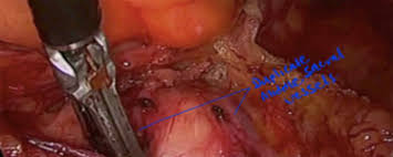 Maybe you would like to learn more about one of these? Laparoscopic Surgical Anatomy For Pelvic Floor Surgery Sciencedirect