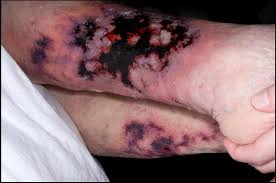Because of its inflammatory and violaceous wound edges and its. A Surfeit Of Possibilities Nonhealing Ulcers The American Journal Of Medicine