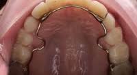 If your retainer breaks you should see your orthodontist and find out whether they advise its removal or replacement. Permanent Retainers Vs Removable Retainers Which Is The Right Option For You Cater Galante Orthodontics