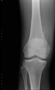 Medial femoral condyle fracture study results. Distal Femur Fractures Trauma Orthobullets