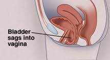 Pelvic Organ Prolapse Surgery For Incontinence Saint Luke S Health System