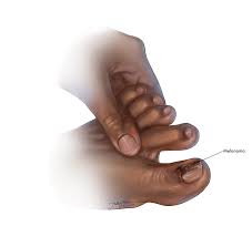 Image result for Acral lentiginous melanoma nail