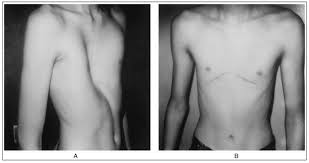 A brace may be used to treat children and young adolescents. Repair Of Pectus Excavatum And Carinatum In Adults Sciencedirect