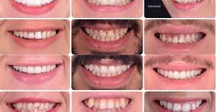 İmplant yaptırırken kulaktan dolma bilgilere inanmayın veya internetten okuduklarınızla hareket etmeyin dental implantlar günümüzde çok popüler. Zirkonyum Dis Nedir Zirkon Ve Porselen Dis Kaplama Fiyati Istanbul Turkiye