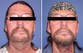 Robotic Reconstructive Surgery