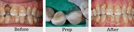 Dental Bridges To Replace Missing Teeth Wimborne Poole Dorset