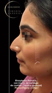 Rinoplastia Primaria con injerto de cartílago de costilla (técnica  personal). A 2 años de operada., Primary rhinoplasty with rib cartilage  graft (personal technique). 2 years after surgery.