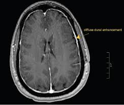 Intracranial Hypotension Syndrome Consultant360