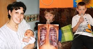 Cystická fibróza je velmi vážné a i přes pokroky medicíny v posledních letech nevyléčitelné onemocnění. Alena Ma Slane Deti Zakernou Chorobu Dychacich Cest Trpi Oba Jeji Synove Blesk Cz