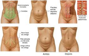 Resultado de imagem para ABDOMINAIS