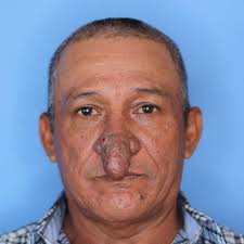 Man with deformed nose gets life-changing surgery