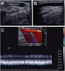 The median cubital vein is often used for venipuncture. Ultrasound Characterisation Of The Vein Two Dimensional Ultrasound And Download Scientific Diagram