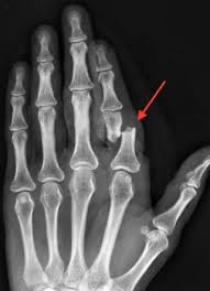 Therapieabwagung Beim Enchondrom Knorpel Tumor Handerkrankungen