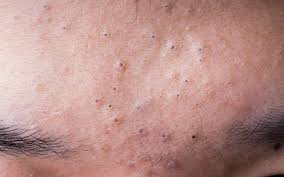 En plus de nettoyer et détoxifier la peau profondeur la peau, ils. Video Comedons Pourquoi Ne Faut Il Pas Percer Les Points Noirs