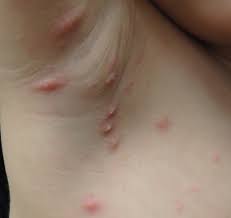 Image result for scabies in the groin area