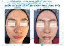 ĐIỀU TRỊ SẸO MÁ VÀ RHINOPHYMA VÙNG MŨI