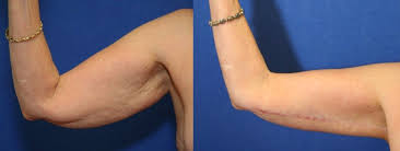 Herkes Bir Yerinden Sikayetci Iste Dunyada En Cok Yaptirilan 17 Estetik Ameliyat Onedio Com