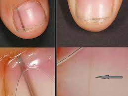melanonychia striata altmeyers encyclopedia department dermatology