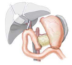 Mysurgery Pankreaskarzinom