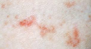 Image result for scabies on genitals