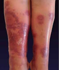 Image result for Localized Edema