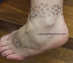 Reset tattoo removal & skin rejuvenation medspa is very proud to be chicago's first medspa. Eclipse Tr Tattoo Removal Pen No Match For Picosure Laser Austinpicosure Com A Tattoo Removal Nurse S Notes