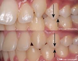 Braces may take 18 to 24 months to fix overbite and all related problems. Overbite Treatments Braces In South Brunswick Nj