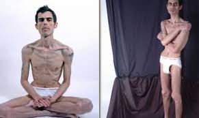 Resultado de imagen de anorexia idealizada