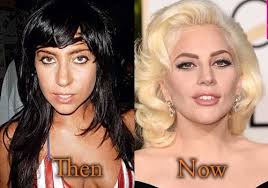 Pin On Celebrity Plastic Surgery