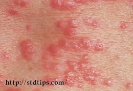 Pin On Liver Disease