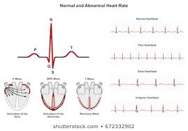 Royalty Free Ecg Arrhythmia Stock Images Photos Vectors