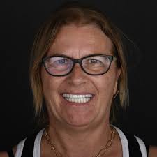 Dental Implant Case Study in Turkey