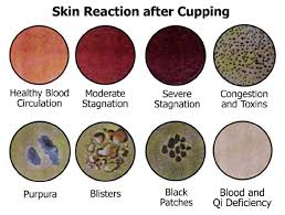 Cupping Therapy Detoxification