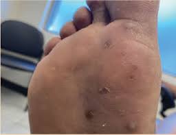 Image result for brown patches on the feet