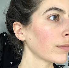 Learn how light therapy for rosacea can stop the burning fast, heal redness over time, and help prevent permanent damage to your skin. Essential Oils For Rosacea My Story What S Helped Pumps Iron