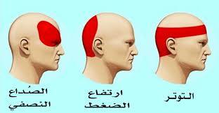 صداع في مؤخر الراس الم الراس المستمر عيون الرومانسية