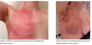 Image result for Radiation Dermatitis
