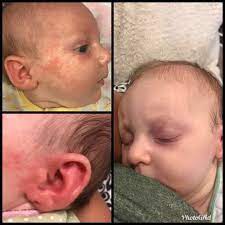 My 8 Week Old Started Out With Baby Acne And It Turned Into Heat Rash With Blisters It Got So Bad That Her Poor Eye Baby Acne Baby Eczema Treatment Baby Rash
